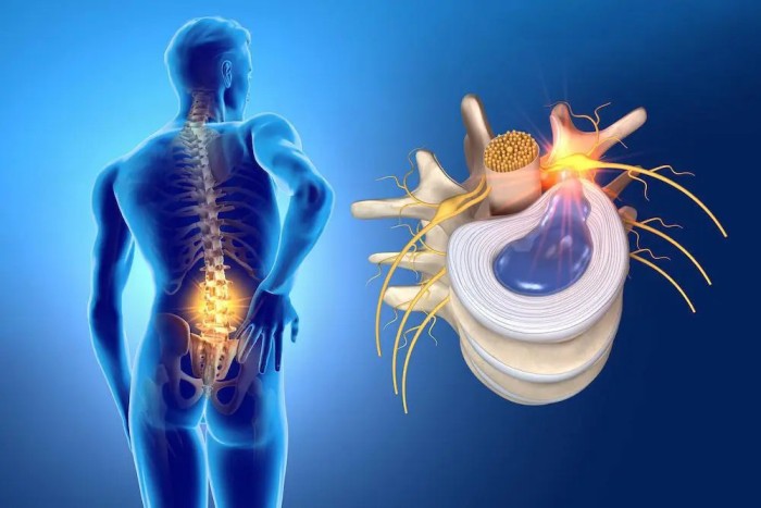 Đau lưng lan xuống mông và chân