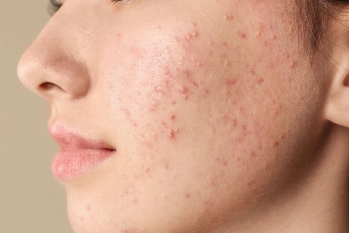 Nguyên tắc chữa mụn trứng cá bằng Đông y