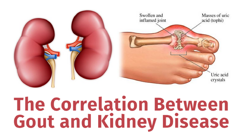 gout và thận
