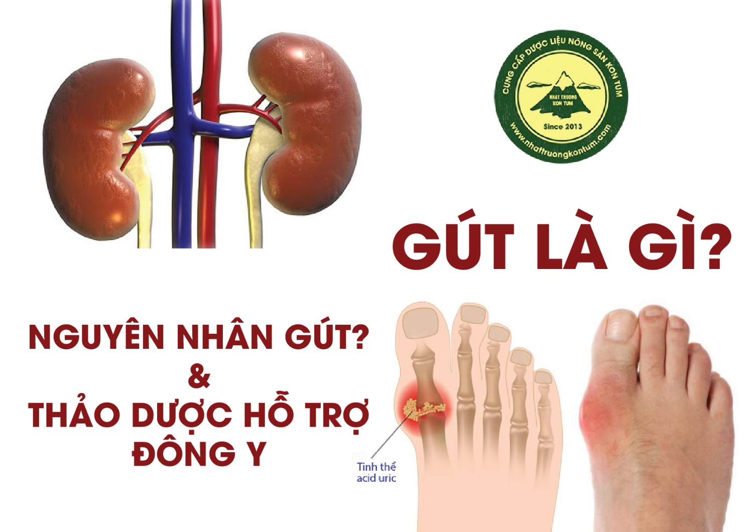 Định nghĩa Bệnh Gout theo Y Học Hiện Đại và Đông Y có phần hơi khác nhau
